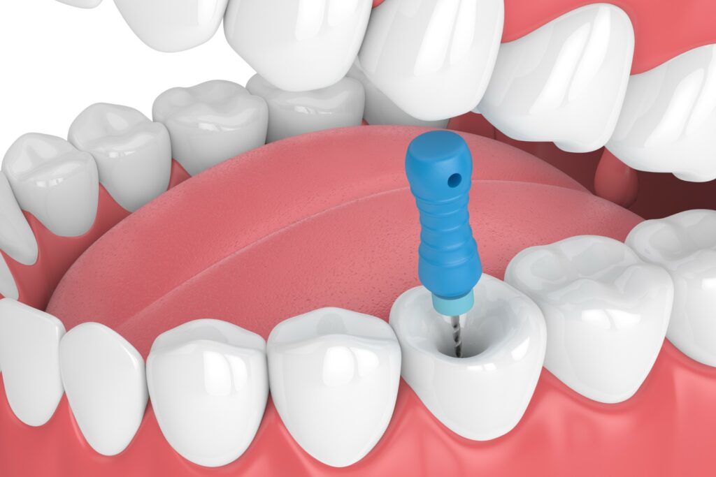 Root Canal Treatment Eynesbury